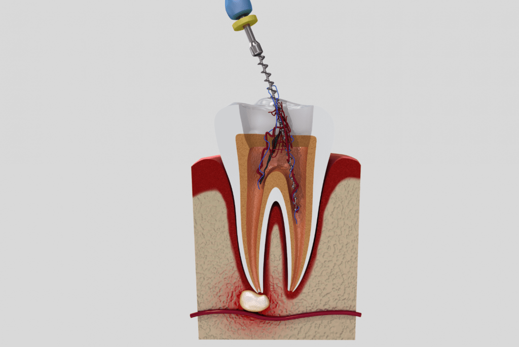 Endodonti - Kanal Tedavileri uzman bir hekim tarafından yapılmadığında başarısızlıkla sonuçlanabilen tedavilerdir.