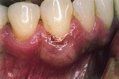 Periodontal hastalıklar diş etlerinde şişlik ve kızarıklıkla karakterizedir.