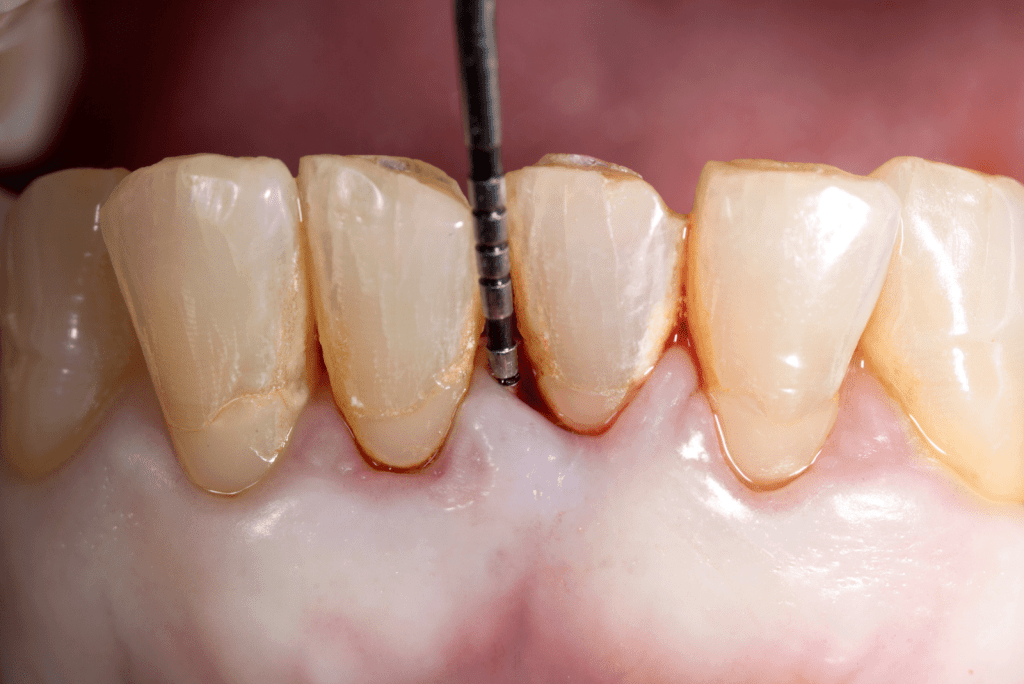 Periodontitis – Diş Destek Kemik Doku Kaybı sondlama denilen yöntemle ölçülebilmektedir.