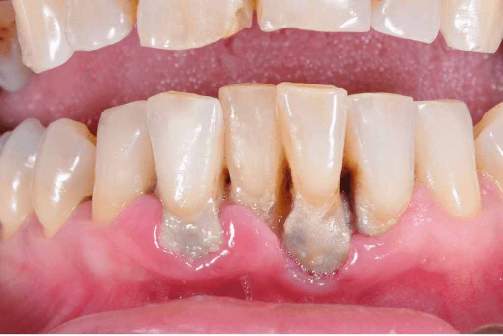 Periodontal hastalıklar diş eti çekilmesine daha ileri durumlarda diş kayıplarına neden olmaktadır.