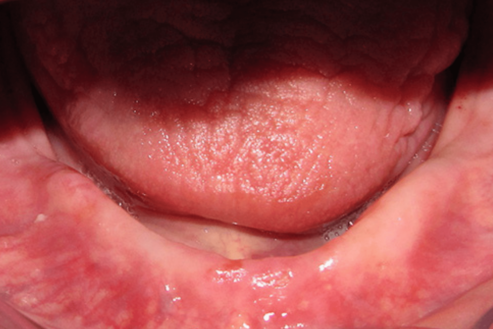 Diş Eti Tedavisi - Periodontoloji çene cerrahisi yetersiz sulkus derinliği Yetersiz Bukkal Derinlik