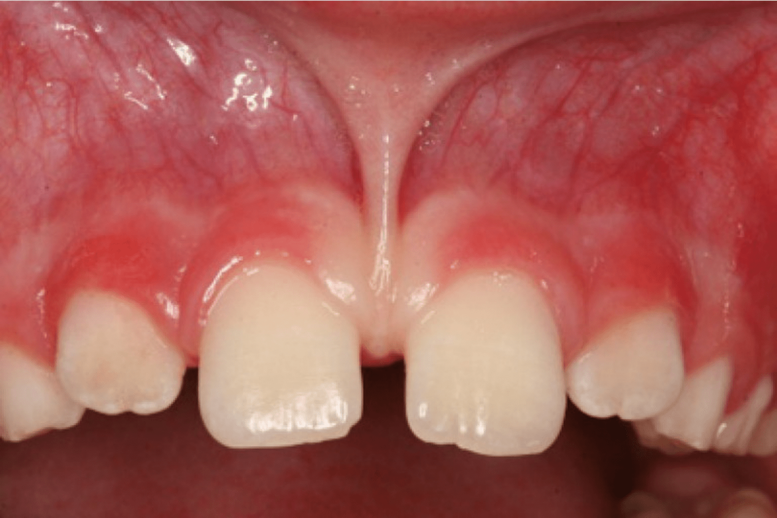 Diş Eti Tedavisi - Periodontoloji Yüksek Kas, Frenulum Ataçmanı