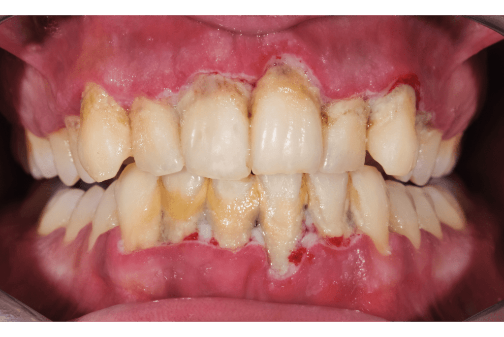 Periodontitis – Diş Destek Kemik Doku Kaybının en önemli nedeni kötü ağız hijyenidir.