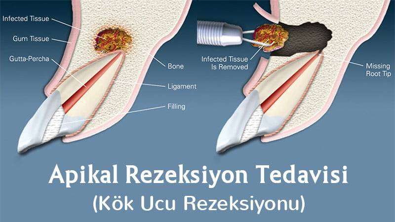 Apikal rezeksiyon ile diş kökündeki enflamasyon ve kist temizlenerek dişin çekimi önlenmektedir.