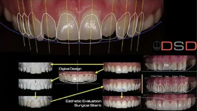 DSD veya bilinen diğer adıyla digital smile design
Gülüş Tasarımı Nedir?
Yazan: Uzm. Dr. Ozan Kefeli (Gülüş tasarımı uzmanı)