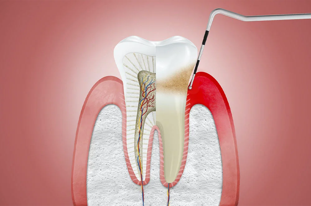 Gingivitis – Diş Eti İltihabı diş etinde en sık görülen hastalıktır.