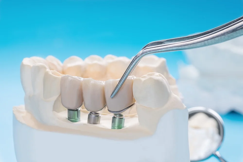 İmplant Rahatsızlıkları dental implant yapımı sonrasında ortaya çıka sorunlardır.