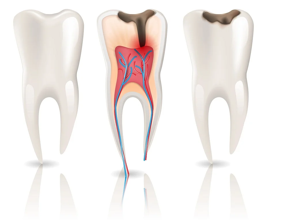 Endodonti - Kanal Tedavileri dişlerin kaybını önlemek için yapılan tedavilerdir. Diş çürükleri ihmal edildiğinde dişler çekme gidebilir.