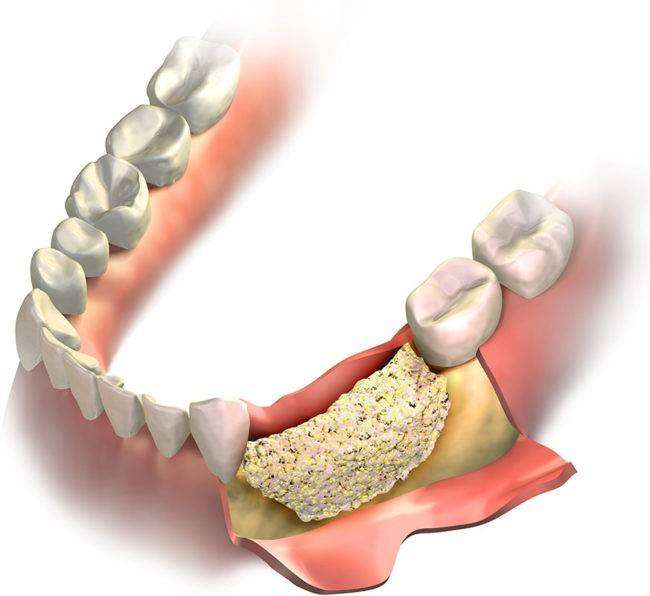 Alveoler kemik augmentasyonu