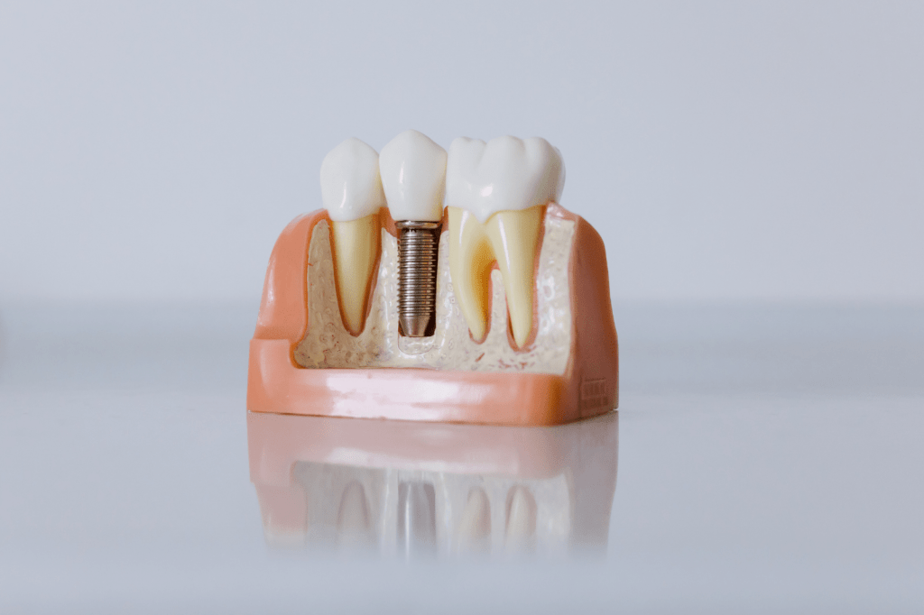 Dental İmplant Vakalarında Sonuçlar ve Başarı kriterleri Nelerdir?