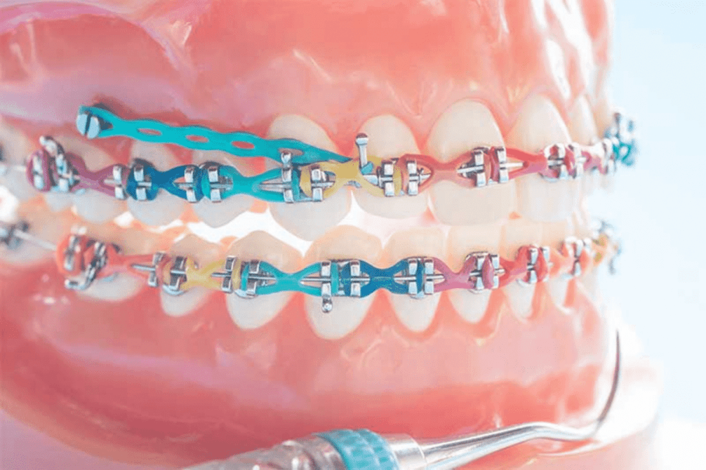 Ortodontik Mini Vidalar nedir?
mini vidalar ne işe yarar?
Yazan: Uzm. Dr. Özlem Aylıkcı (Ortodonti uzmanı)